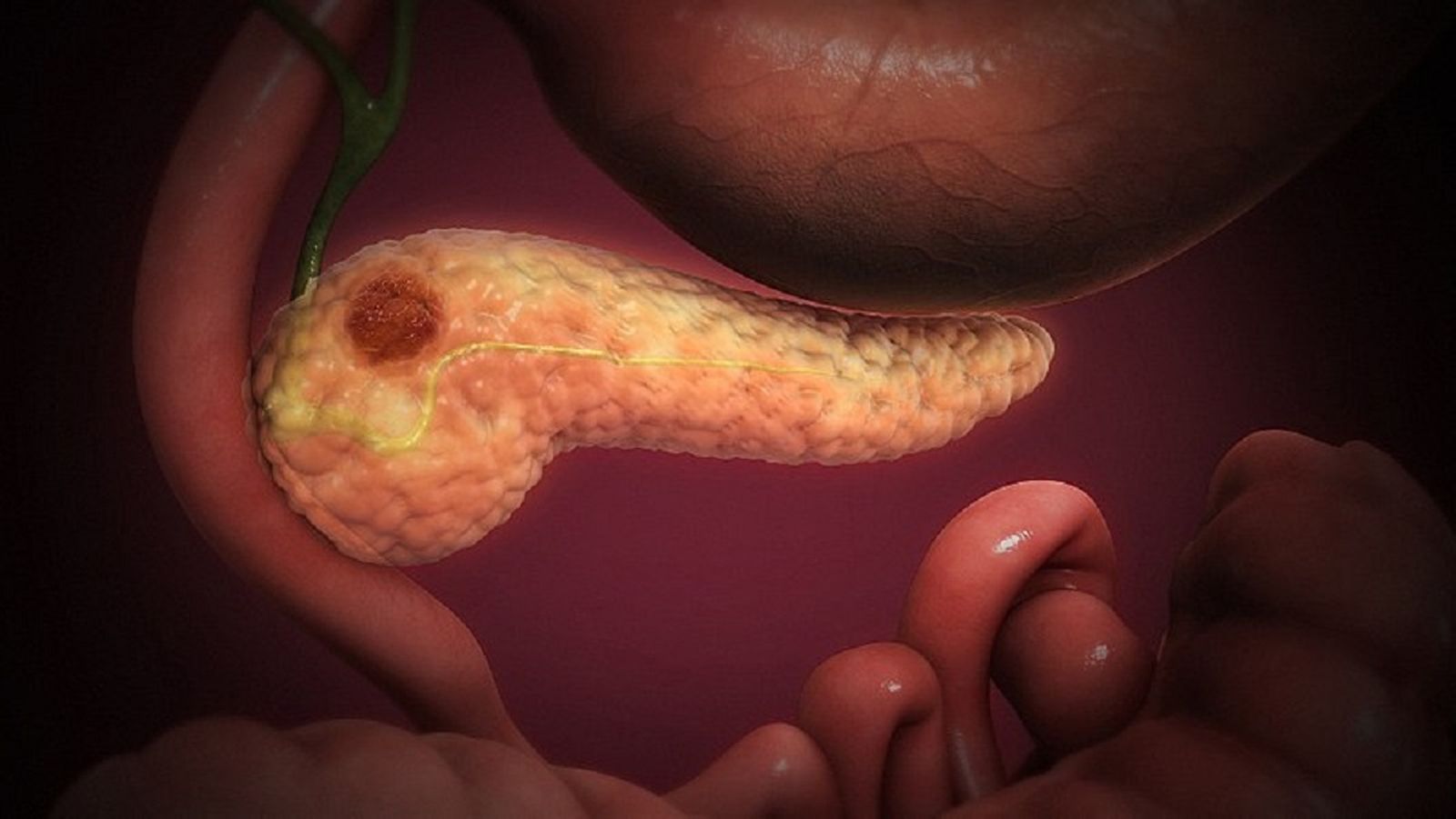 Tumor en el páncreas