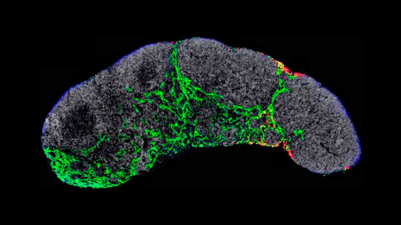 Científicos españoles descubren cómo frenar la metástasis del melanoma