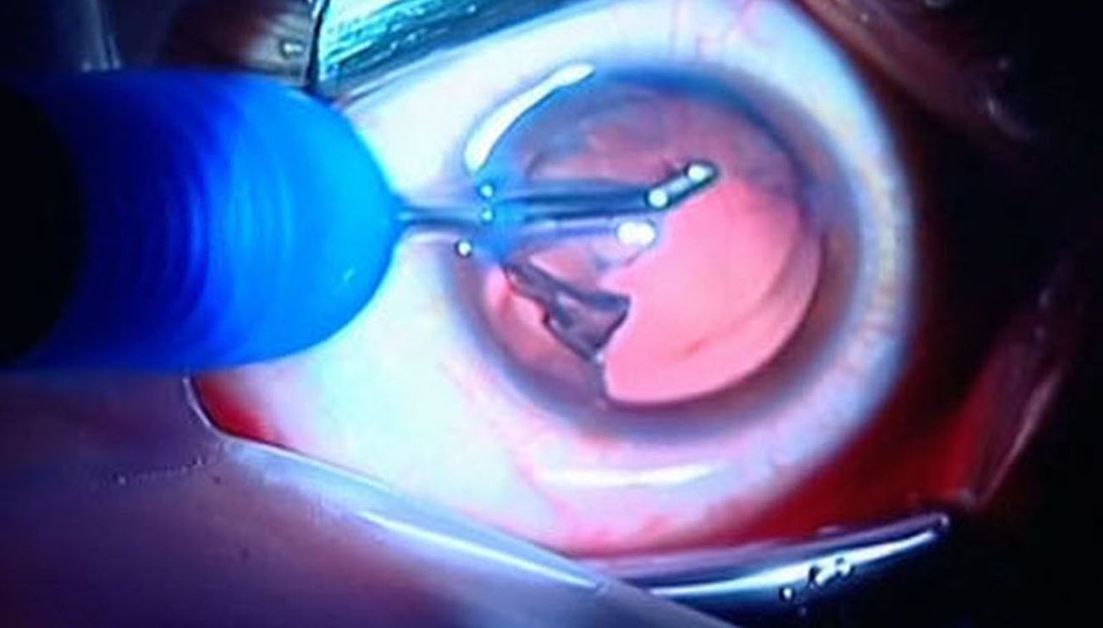 Eendoscopia