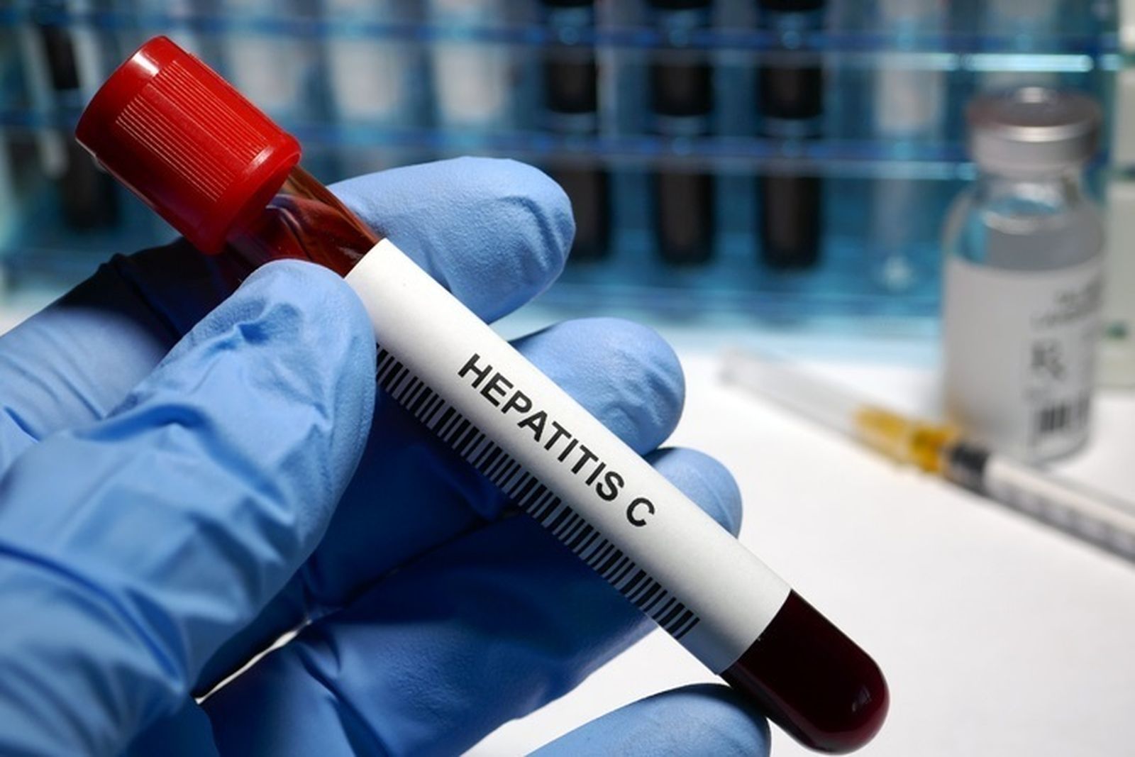 Muestra de sangre con hepatitis C