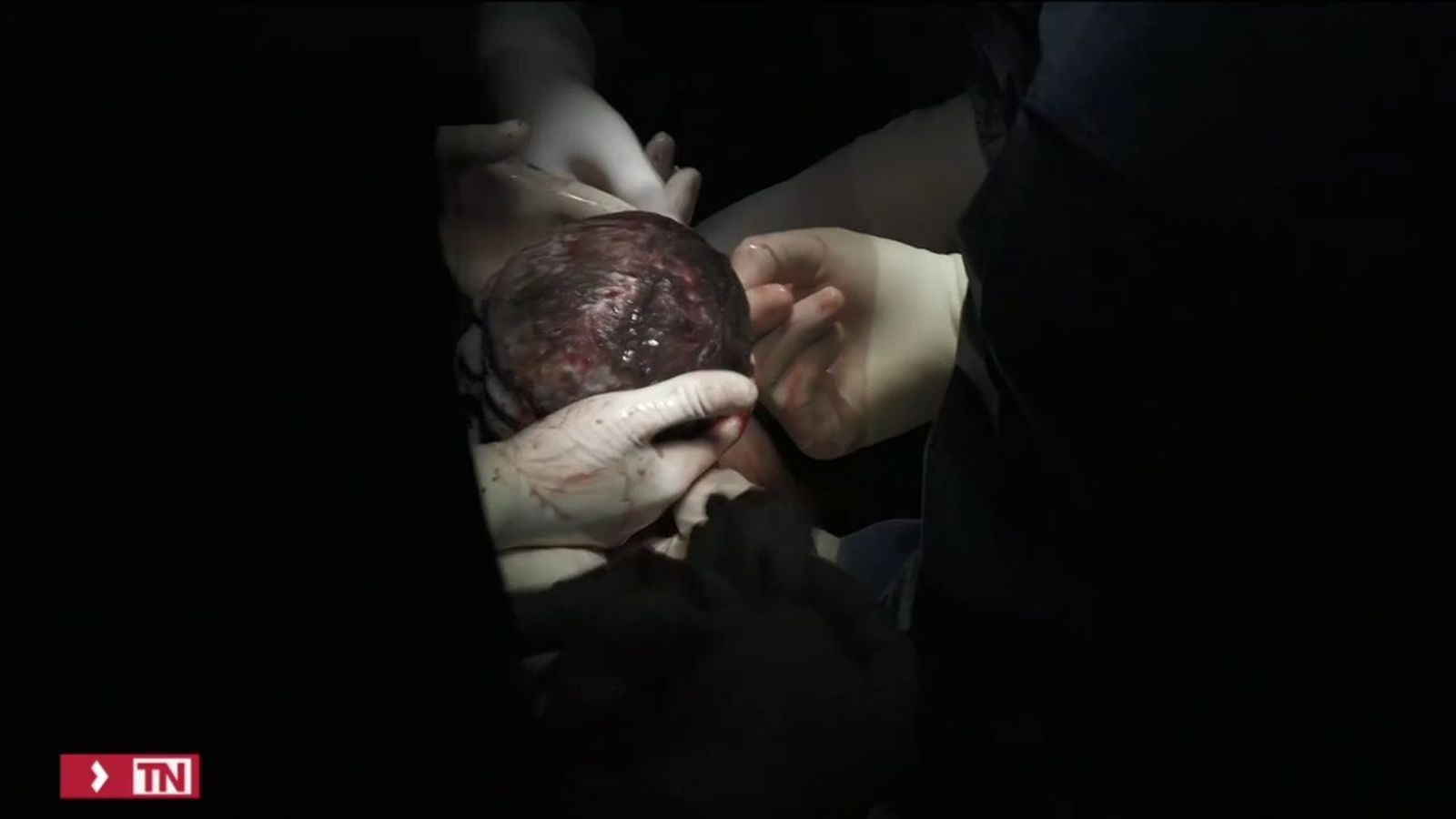 Nace un bebé de un útero transplantado