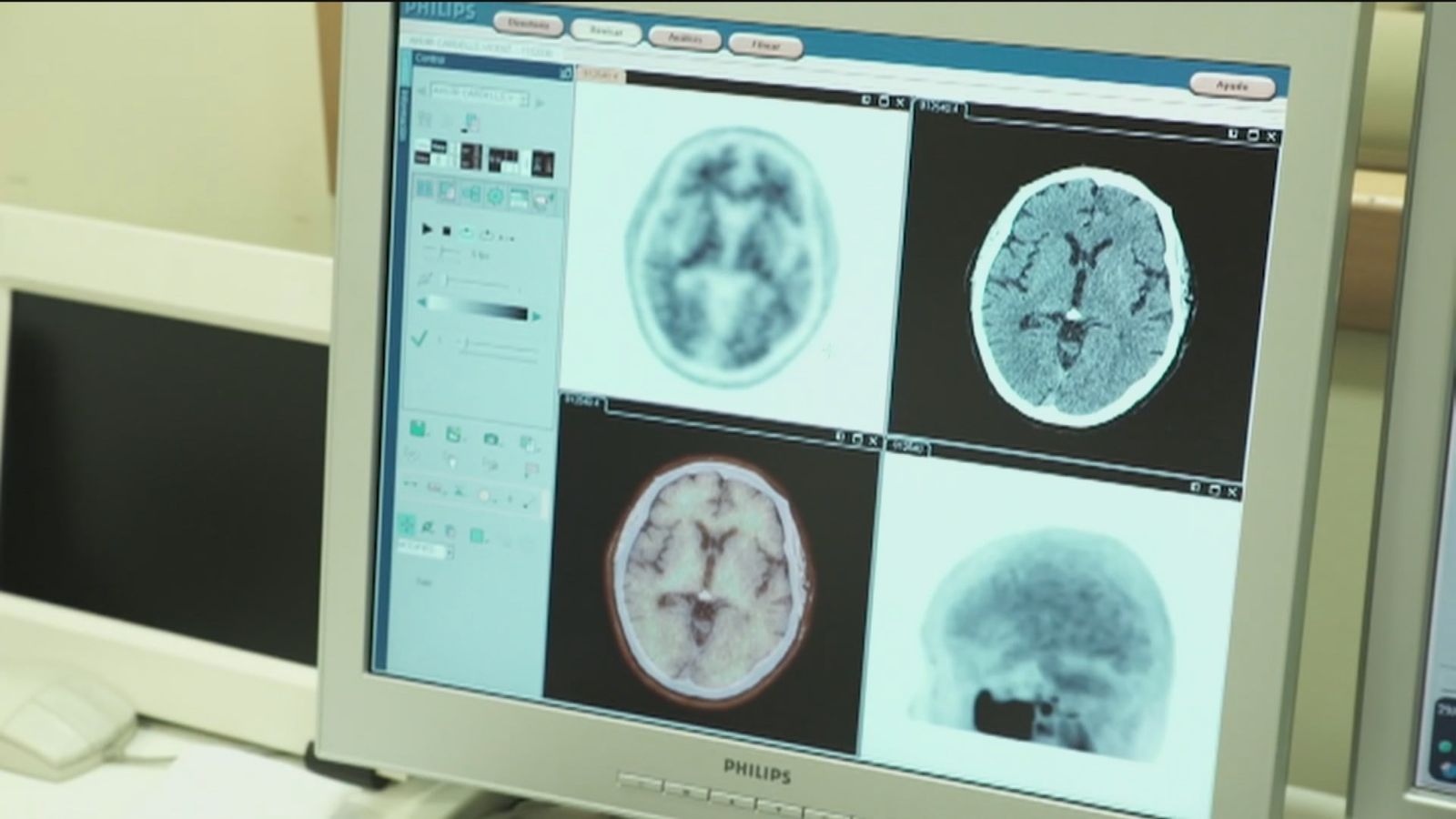 Estudio sobre la enfermedad de Alzheimer