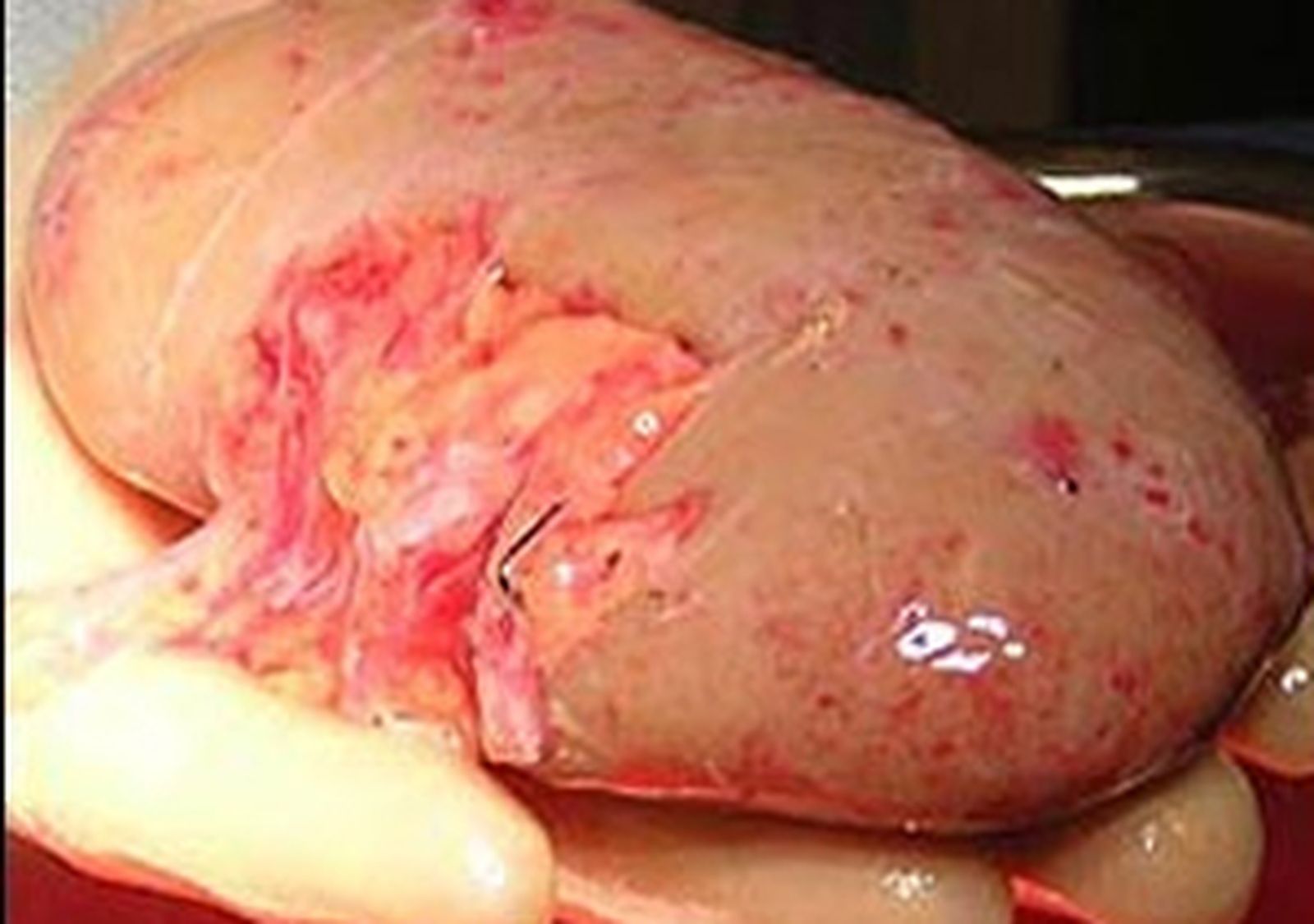 rinon_transplante