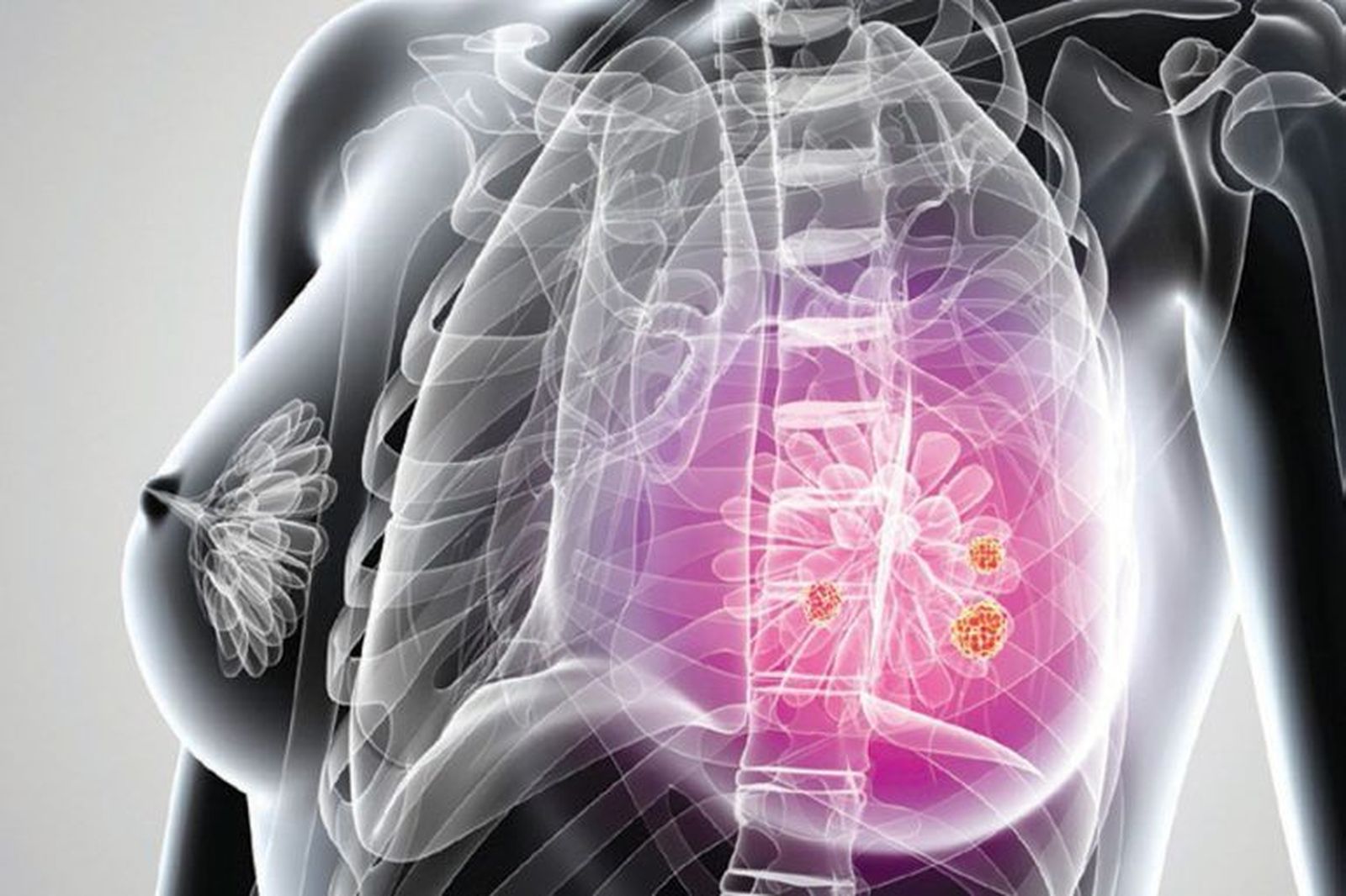 La cirugía oncoplástica permite la conservación de la mama en caso de cáncer