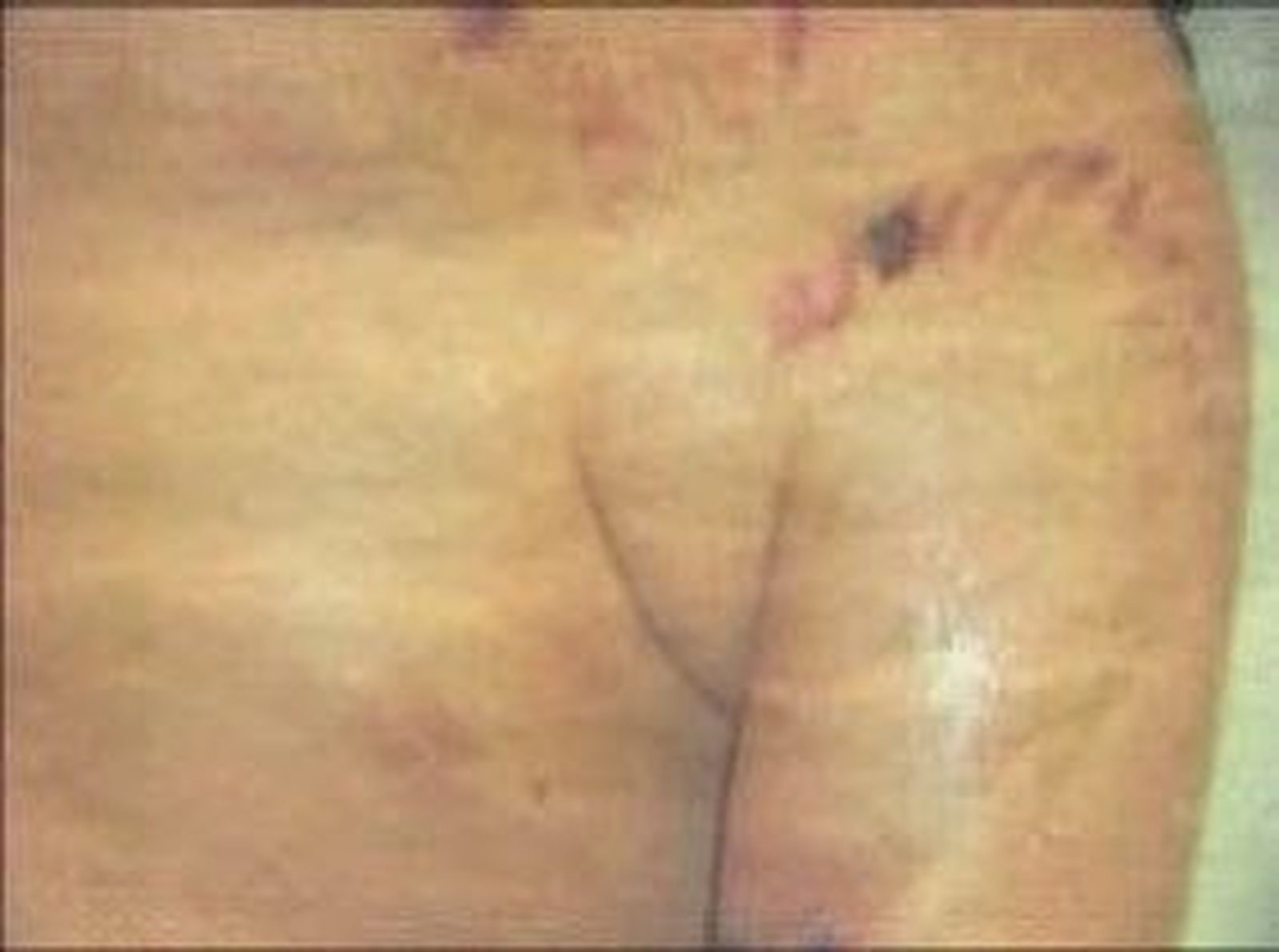 Agresión de un pitbull a un niño