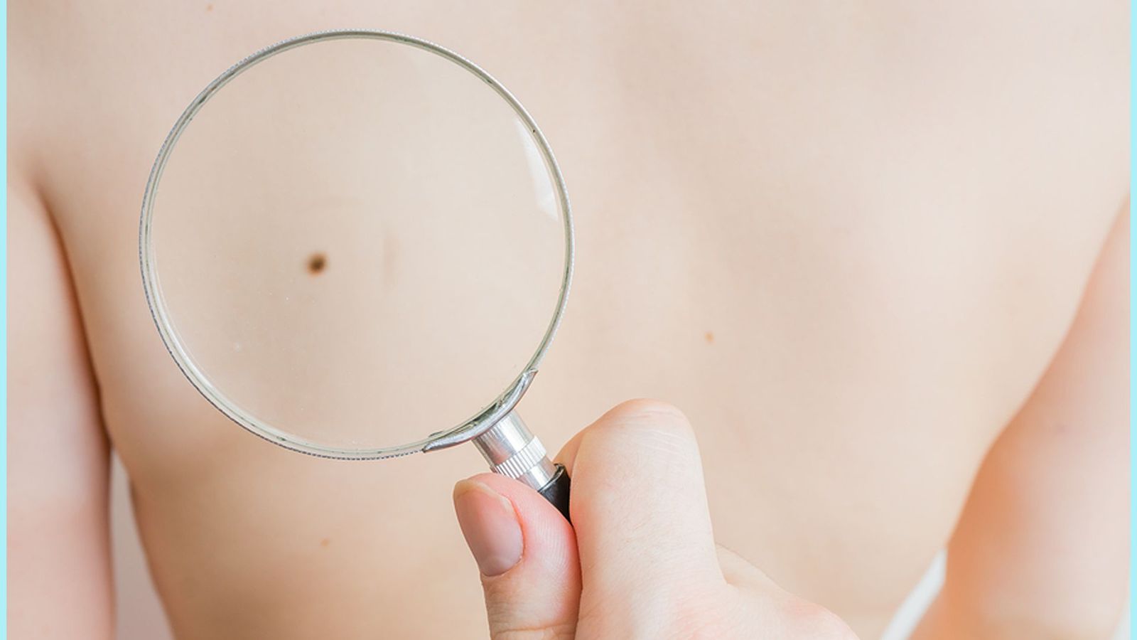 Los centros de salud de Madrid incorporan el dermatoscopio para detectar el melanoma