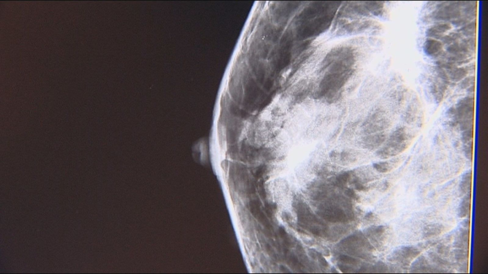 Un nuevo fármaco contra el cáncer de mama