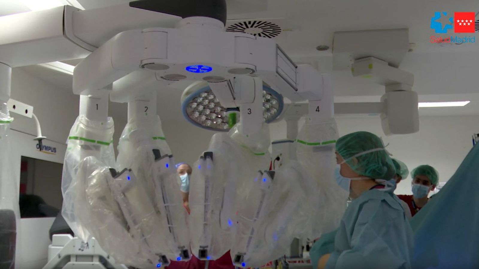 Extracción parcial de hígado de donante vivo mediante cirugía robótica
