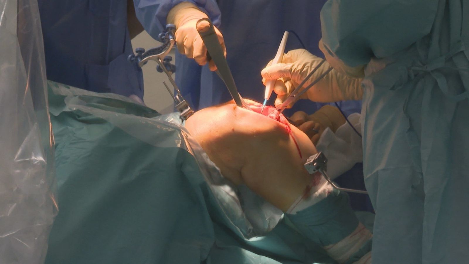 El Hospital del Tajo incorpora un brazo robot que optimiza las cirugías de rodilla