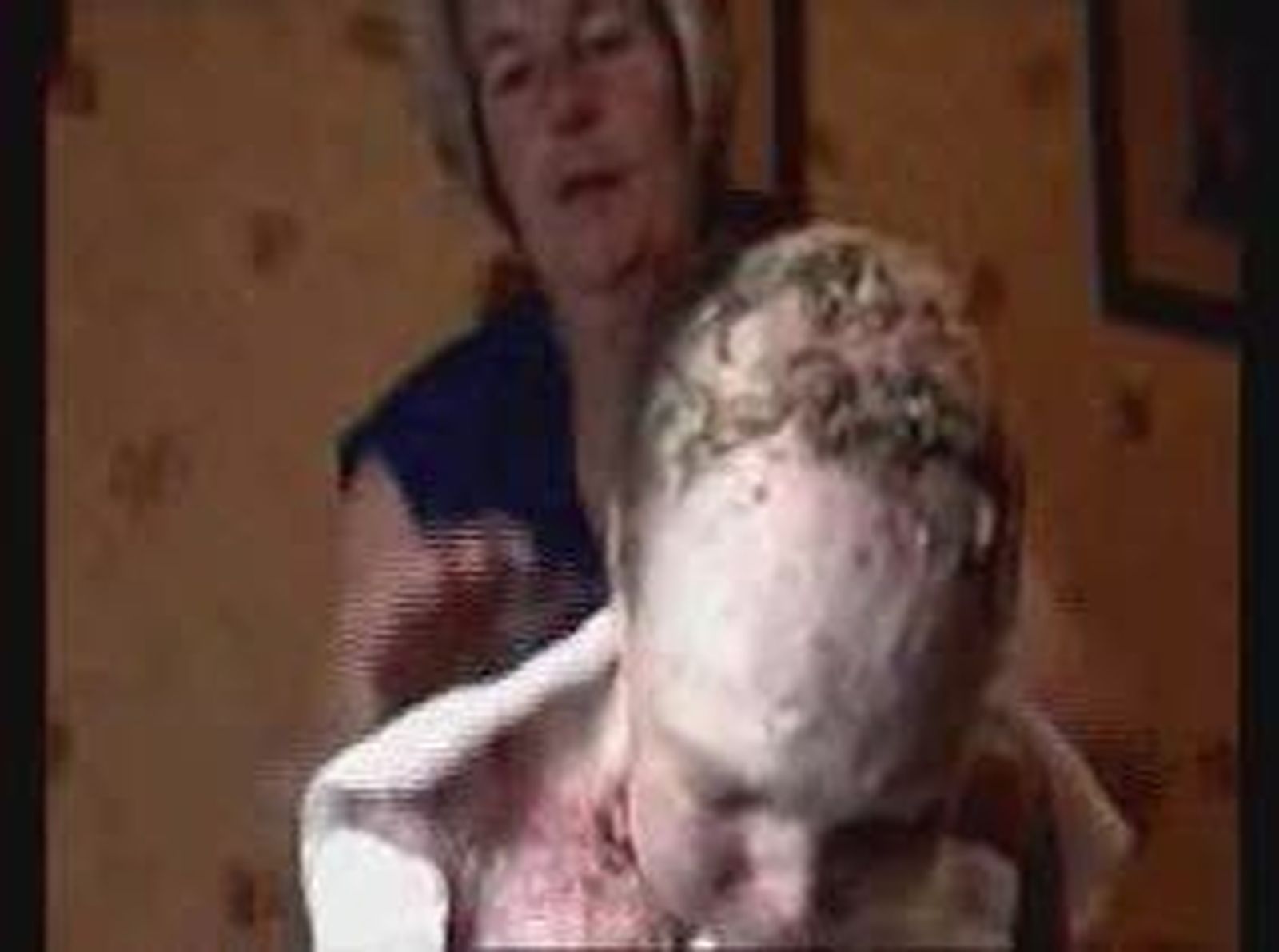 Epidermolisis bullosa