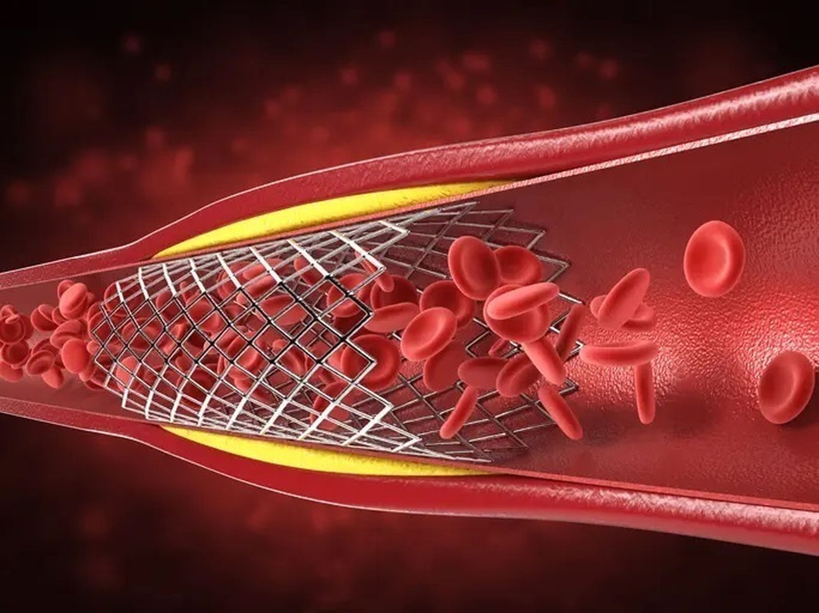 Imagen de un stent