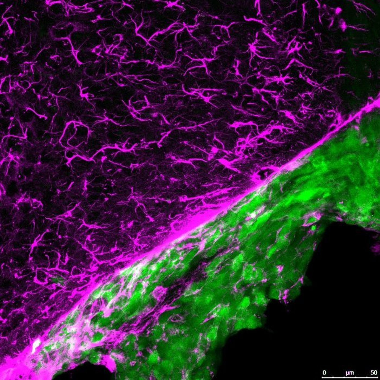Metástasis (verde) creciendo en el cerebro (morado)