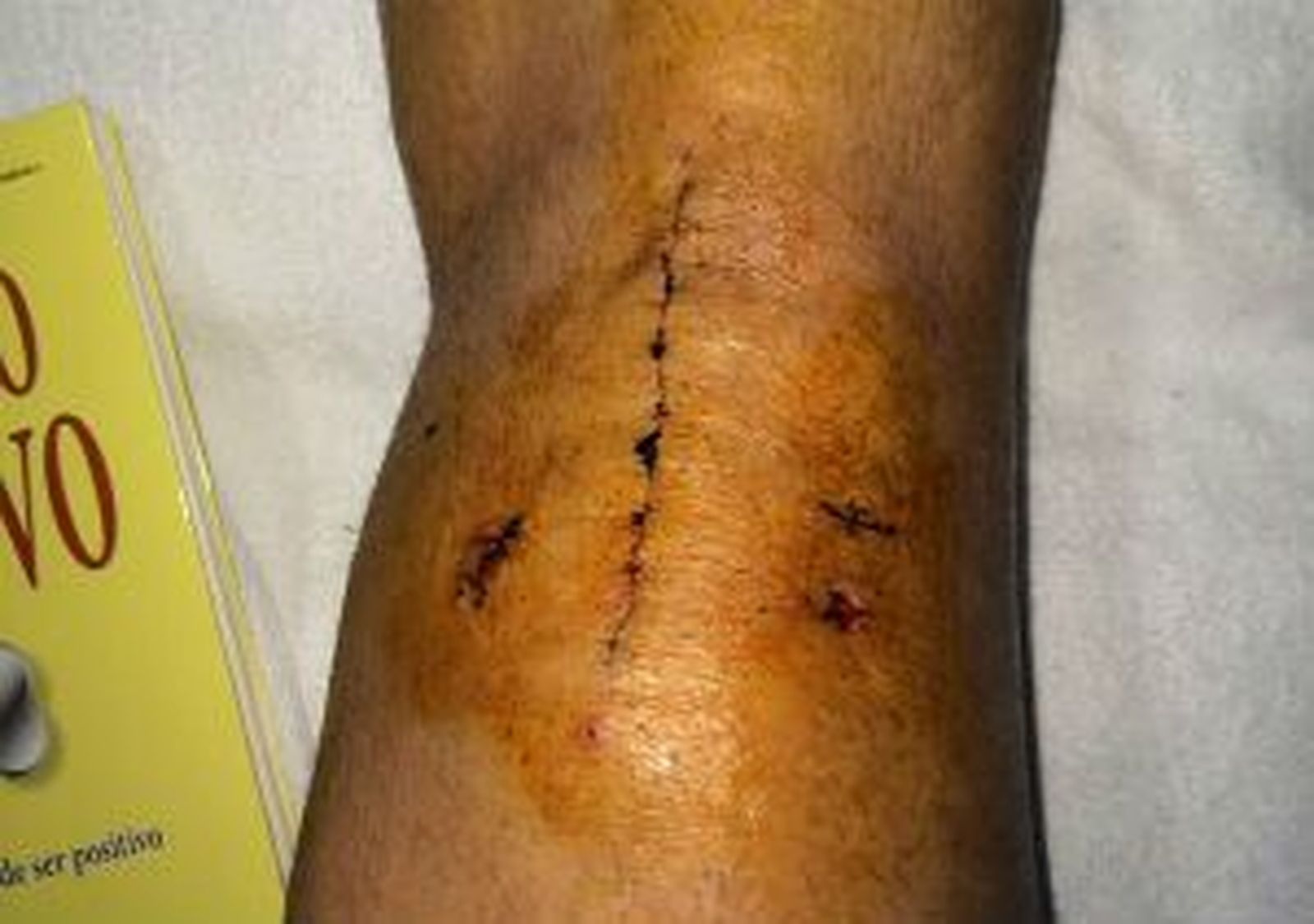 Jesé muestra la rodilla operada: "Vamos avanzando"