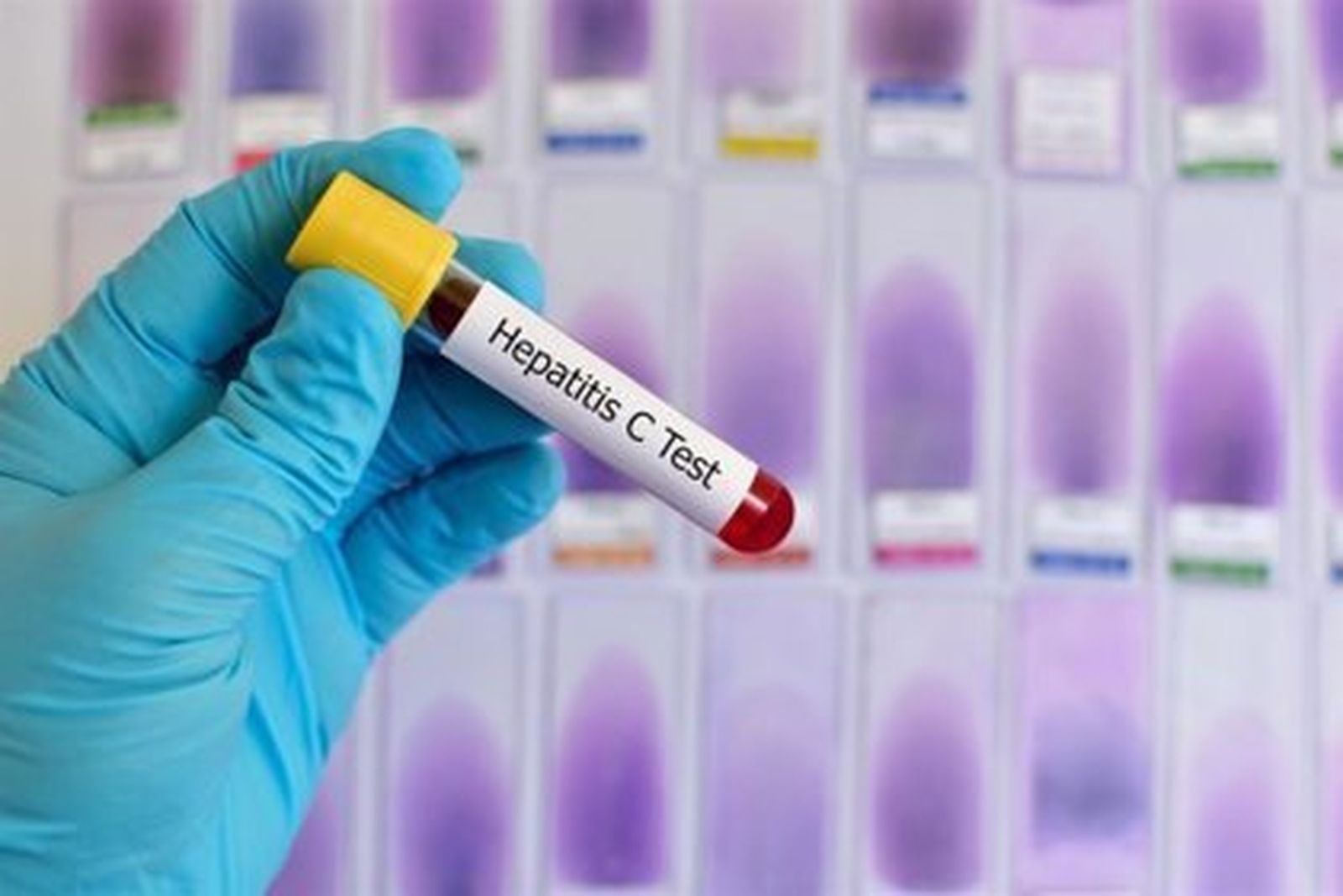 Dos muertes por hepatitis desconocida