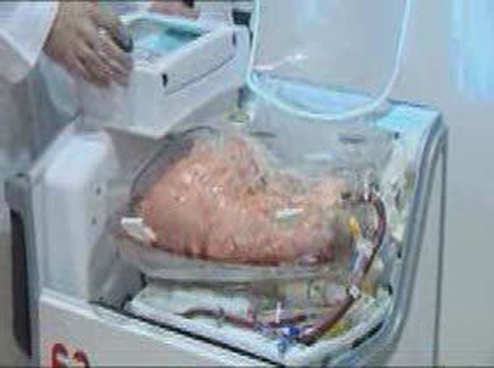 El Puerta de Hierro presentan un sistema para que  los pulmones para transplantes "sigan respirando"
