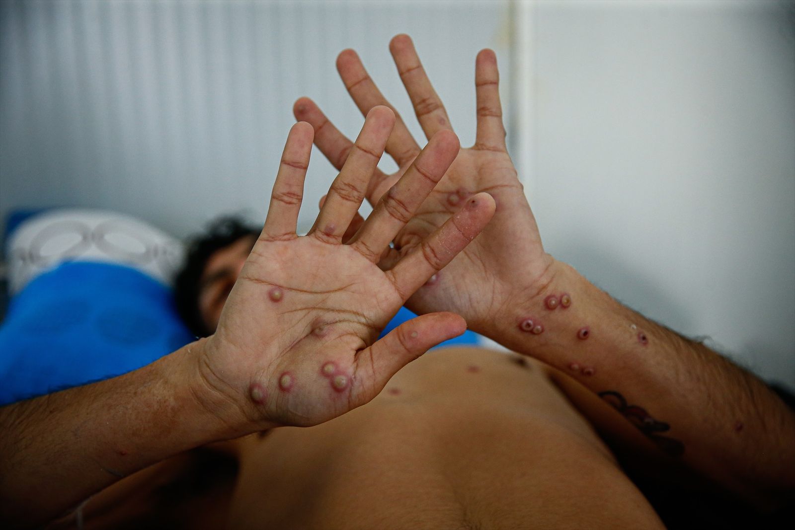 Persona internada con mpox (viruela del mono)