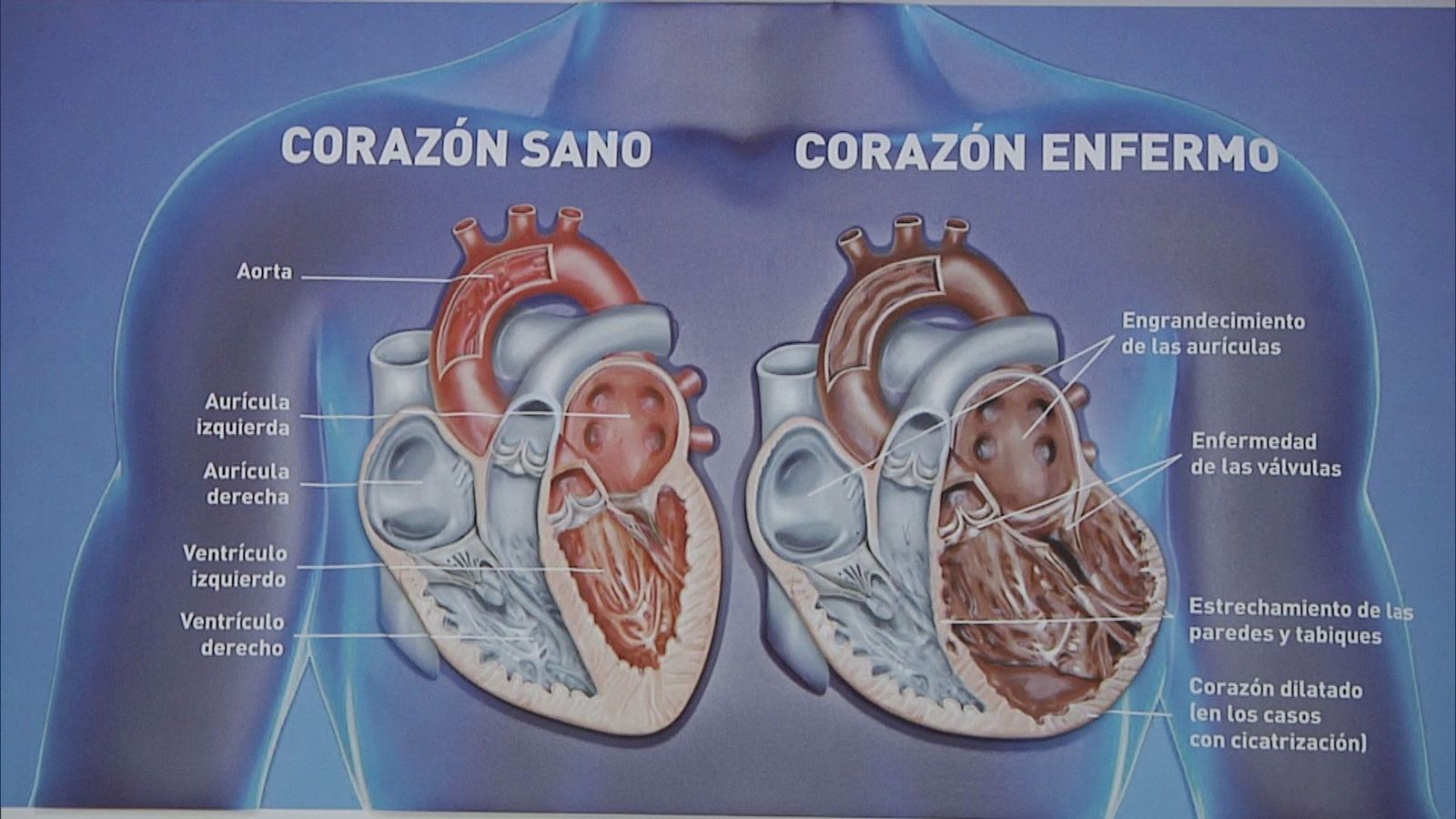 Insuficiencia cardíaca: una patología silenciosa pero común